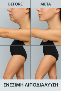 λιπολυση λυποδυστροφια